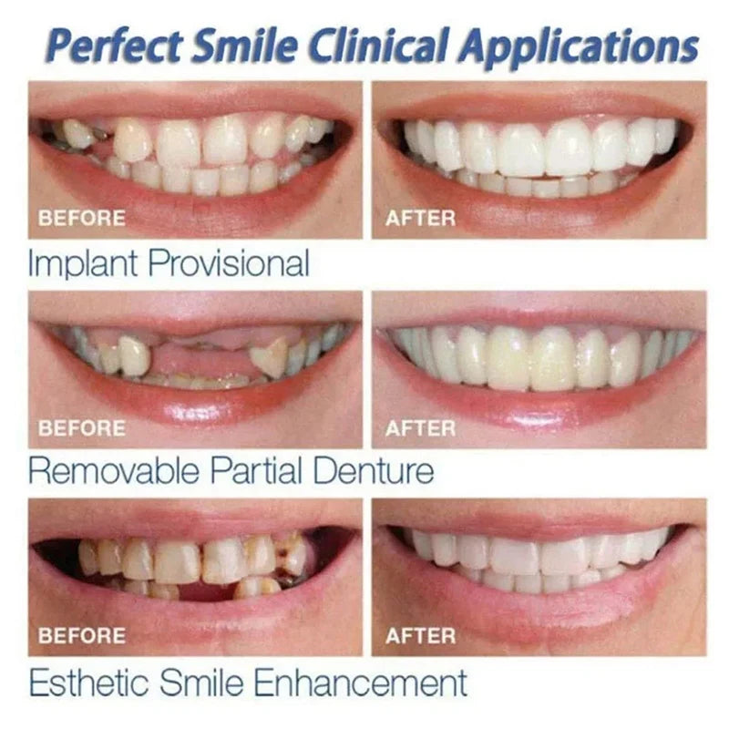 Denture Cover Veneer Snap-on Teeth Kit Fake Temporary Tooth Whitening Replacement Temporary Tooth Replacement Tooth Model