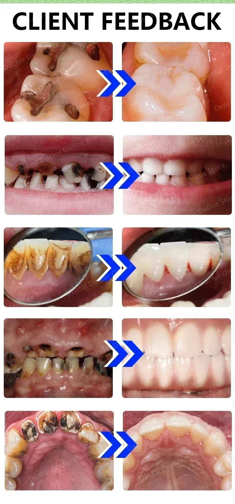 Tooth decay Repair Repair all cavities, protect teeth remove plaque stains Tooth decay repair teeth whitening Dental
