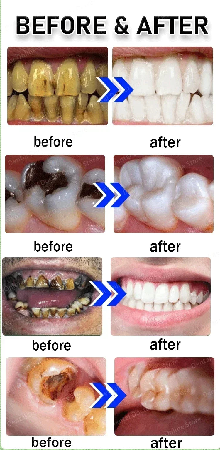 Tooth decay Repair Repair all cavities, protect teeth remove plaque stains Tooth decay repair teeth whitening Dental